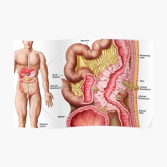 Discover Illustration of diverticulosis in the colon. Premium Matte Vertical Poster