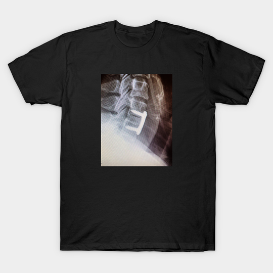 Discover Implant X-Ray - Implant X Ray - T-Shirt